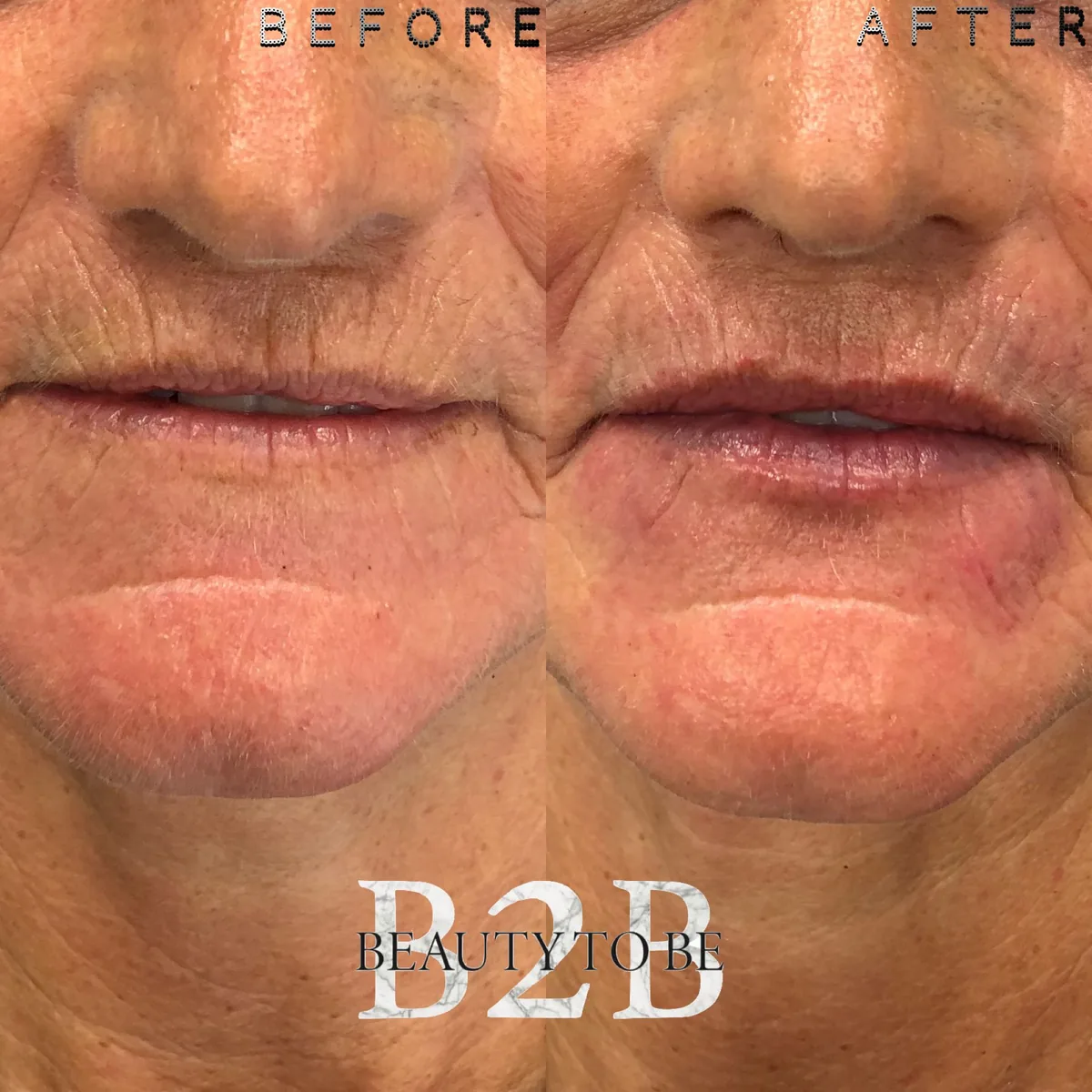 Injectable resultaat