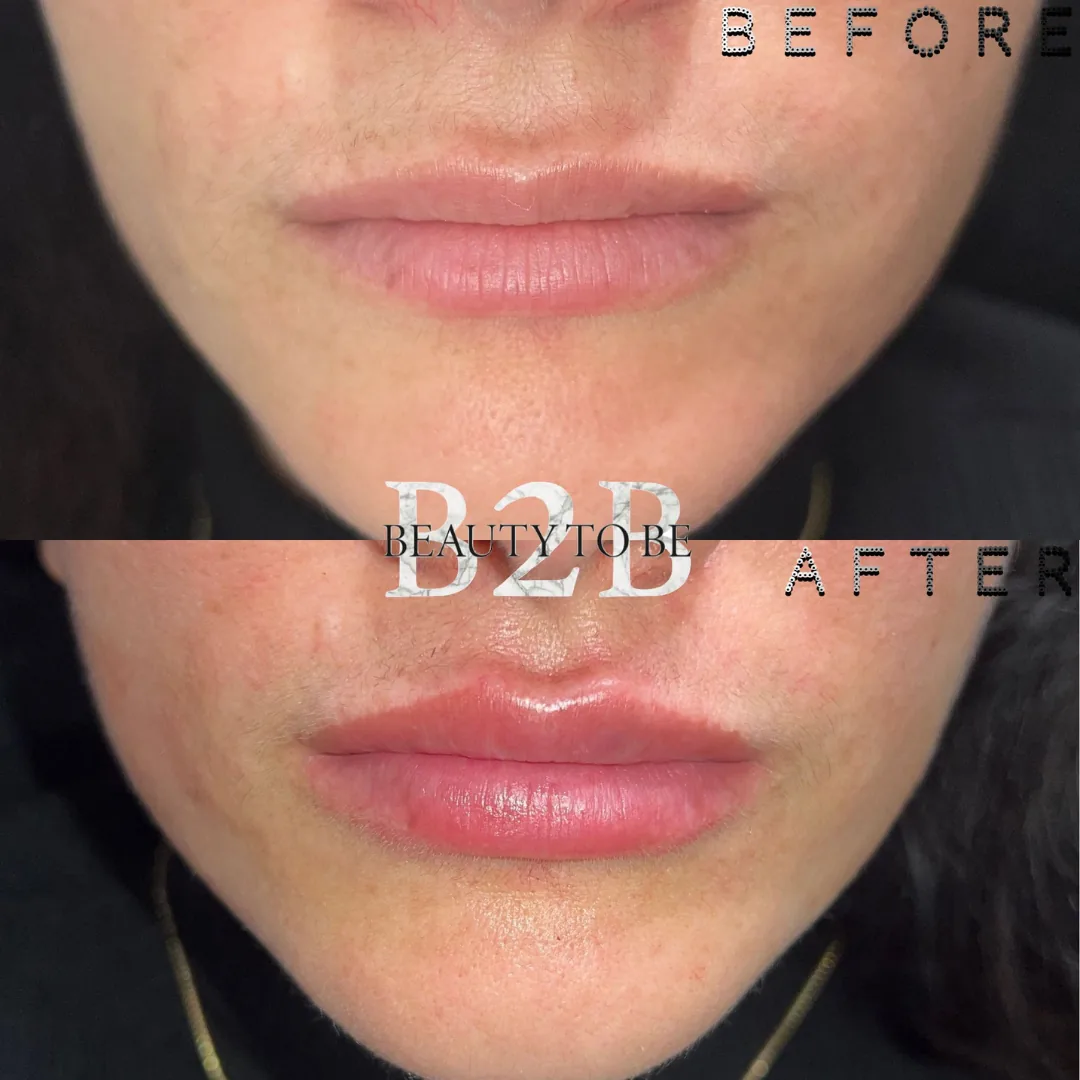 Lipresultaat 01: voor en na bij Beauty To Be
