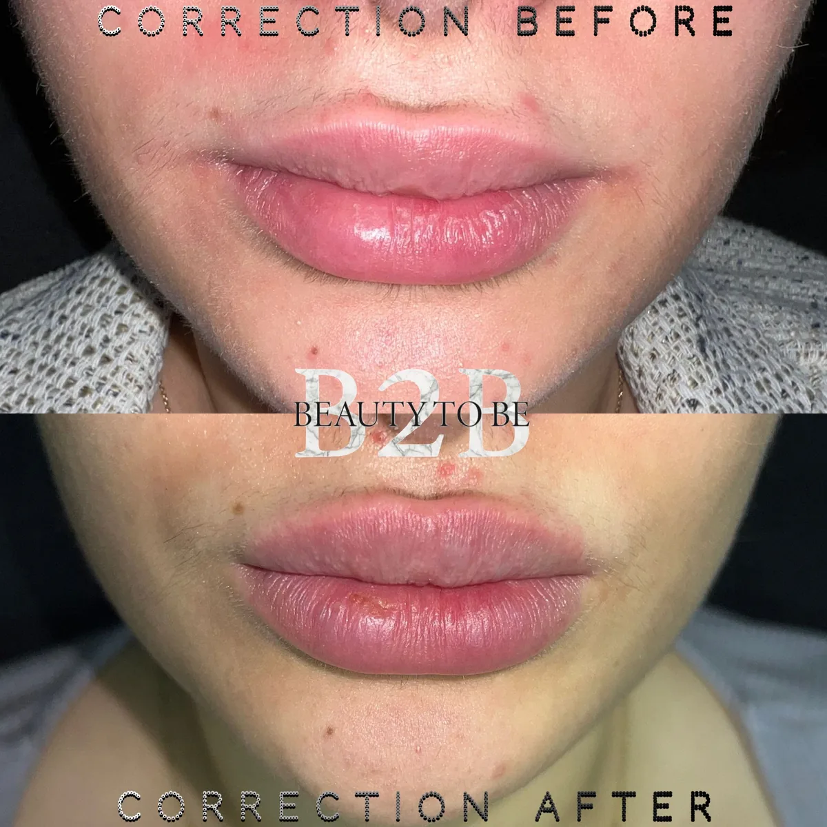 Lipcorrectie