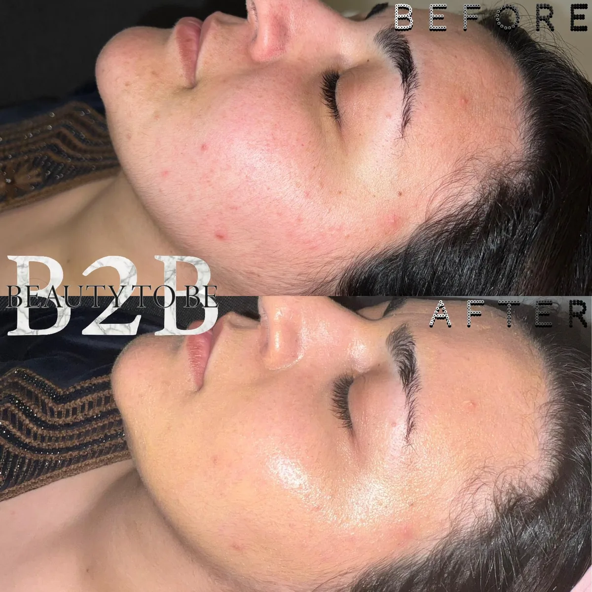 Huidresultaat 01: voor en na bij Beauty To Be